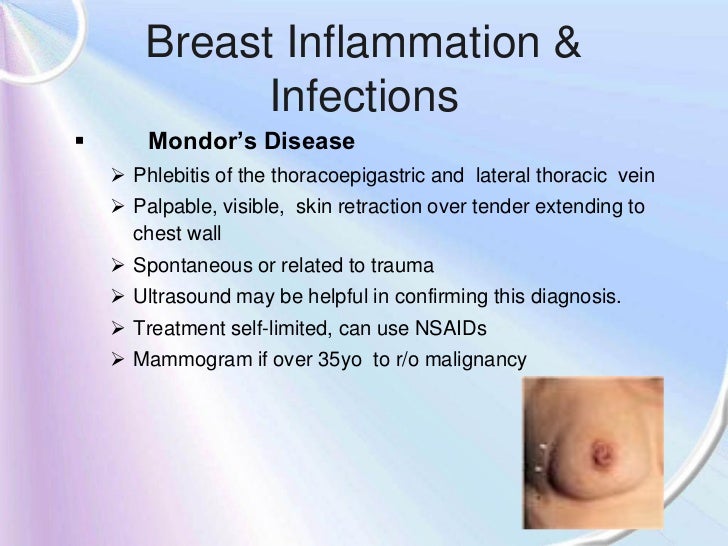 phlebitis in breast Phlebitis in breast